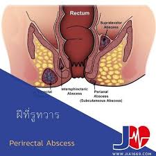 Image result for Perianal Abscess