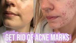 We did not find results for: 1 Month Tretinoin Retin A Update Acne Acne Scars Wrinkles Youtube
