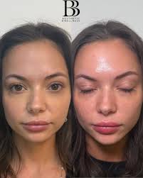 Dysport glow + lip flip perfection! ✨ Always trust @bbaesthetic for these  amazing results. #Dysport #SkinGoals #LipFlip #BBAesthetic #MainevilleOhio