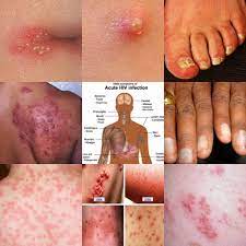 What are the symptoms of hiv? One Of Hiv Symptoms Is Rash A Very Important Article To Read By Majestic Glow Collection Medium