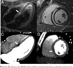 Of these, 20 had no cardiovascular symptoms and had normal ecgs, echocardiography. Figure 2 From Acute Myocarditis Demonstrated On Ct Coronary Angiography With Mri Correlation Semantic Scholar