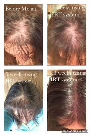 Biotin is in every hair growth pill. Diy Essential Oil Blend For Hair Growth It Really Works Monat Hair Loss Hair Loss Treatment Hair Loss Shampoo