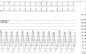Atish Pratap Mathur MD MRCP MPH FACC FSCAI