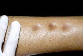 When Those Scary Sock Indentations Don T Mean Edema Scary Symptoms