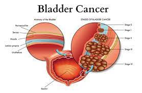 Is bladder cancer common in females? Premier S Bladder Cancer Program Premier Medical Group