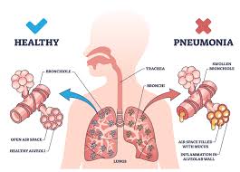 Image result for Pneumonia