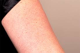 Red spots on the skin are usually small and may appear on the chest, face, arms, legs, and other areas of the body. How To Get Rid Of Keratosis Pilaris Stubborn Red Bumps On Your Skin One Good Thing By Jillee