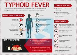 Often there is a gradual onset of a high fever over several days. Bernama Typhoid Fever
