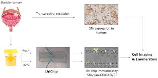 Bladder cancer usually takes a long time to develop, so it is most common in older people. Frontiers Phenotypic Analysis Of Urothelial Exfoliated Cells In Bladder Cancer Via Microfluidic Immunoassays Sialyl Tn As A Novel Biomarker In Liquid Biopsies Oncology