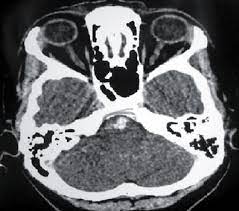 Índice ¿qué es el aneurisma cerebral? Paciente 1 Tomografia De Cranio Corte Axial Com Imagem Em Download Scientific Diagram