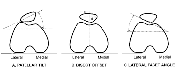Image result for Patellar Tilt Test