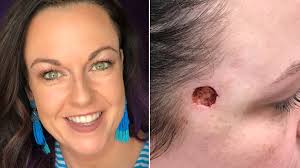 Image result for skin cancer on nose pimple