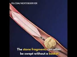 Removing Kidney Stones Surgery 3d Animated Video Youtube Kidney Stones Kidney Surgery