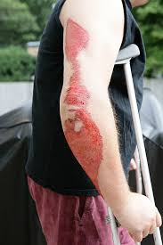 Road Rash Burnaccidentattorneys Com