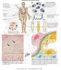 Also called multiple myeloma, kahler disease myelomatosis — a disease characterized by the occurrence of myeloma in various sites. Myelomatosis With Renal Involvement