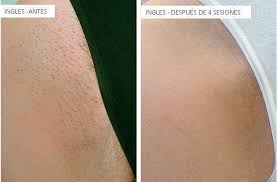 A wide variety of depilacion laser options are available to you Belia Clinic Depilacion Laser Lightsheer