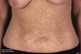 Die behandlung erfolgt mit antipilzmitteln ( antimykotika ), wobei zumeist eine lokale anwendung (als creme, shampoo) ausreicht. Kleieflechte Pityriasis Versicolor Dr Med Ottmar Bogenschutz Balingen