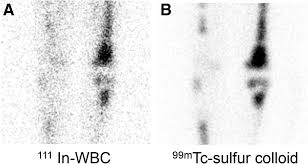 Image result for Osteomyelitis Bone Scan