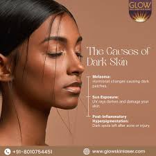Understanding the Causes of Dark Skin Your skin tone can be affected by  various factors. Here are some common causes of dark patches and  pigmentation: 1️⃣ Melasma: Hormonal changes can trigger dark