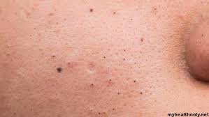 let s know home remes for blackheads