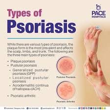 Image result for psoriasis