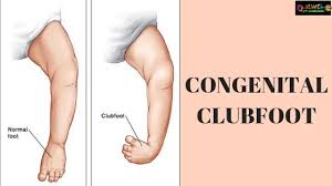 Image result for Clubfoot