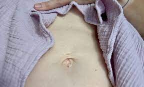 Ein nabelbruch bei neugeborenen und babys ist keine seltenheit. Nabelbruch Op Och No Da Hab Ich Doch Keine Zeit Fur Lacheln Und Winken