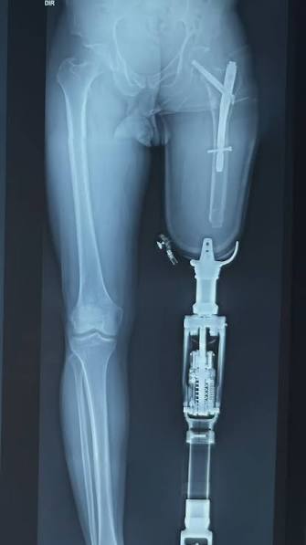 A radiografia panorâmica nos amputados de membros inferiores é um recurso fundamental para avaliação do alinhamento protético., Alguns parâmetros técnicos avaliamos nesse exame:, 1. Ângulo ...