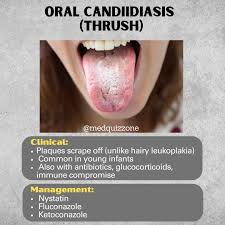 Image result for Oral thrush roof of mouth