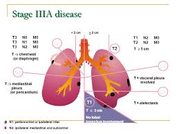 Non Small Cell Lung Cancer Introduction Ppt Video Online Download