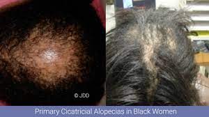 This product belongs to home , and you can find similar products at all categories , beauty & health , hair care & styling , shampoos. Primary Cicatricial Alopecias In Black Women Next Steps In Dermatology