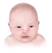 BIRTH DEFECTS SURVEILLANCE