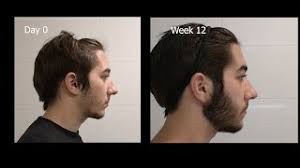 Another report on women using minoxidil also resulted in subjects experiencing severe hypertrichosis (excessive hair growth) on the face and limbs after using 5. Minoxidil Beard 4 Months Results Progress My Beard Oil Company Ihazadream