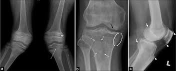The Forgotten Art Of Plain Radiography In The Evaluation Of Metabolic Bone Disease Indian Journal Of Musculoskeletal Radiology Ijmsr