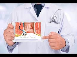 Pulsatilla este indicata pentru hemoroizii care provoaca mancarimi si dureri ascutite ca niste intepaturi. Tratament Naturist Pentru Hemoroizi Din VarzÄ Si Usturoi Youtube