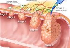 Image result for how long can you survive with colon cancer without treatment
