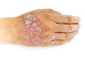 Image result for Pustular Psoriasis