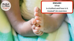 Image result for Clubfoot