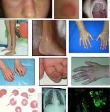 Image result for Connective Tissue Disorder