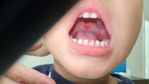 Image result for Canker sores symptoms roof of the mouth