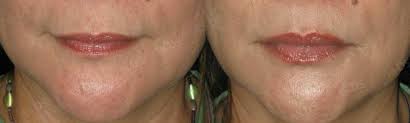 Injectable Hyaluronic Acid