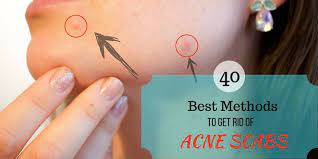 40 Best Ways To Get Rid Of Acne Scabs Overnight | Diy | Home Remedies |  Acne Scab, Back Acne Treatment, How To Get Rid Of Acne