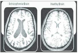 How schizophrenia affects the brain. Difference Of Schizophrenia Brain And Healthy Brain Download Scientific Diagram