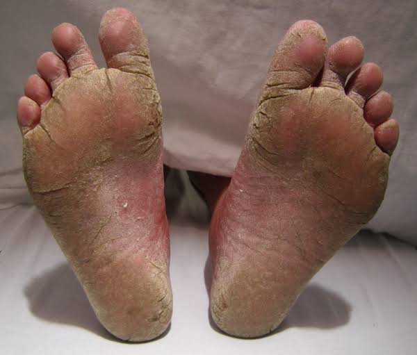Athletes foot