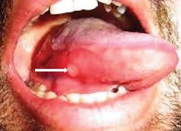 Image result for mouth ulcer on tongue)