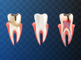 Human Teeth Stages Of Gum Disease Illustration Vector Premium Download Dental Art Root Canal Best Dentist