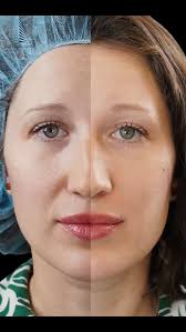 إبرة الشد مش مجرد جلسة تجميل، دي جلسة بتعيد لبشرتك حيويتها وتشد الترهلات من  غير جراحة 💉 النتيجة؟ ملامح أنعم وشكل أصغر بسنين ✨, #علاج_حب_الشباب  #دكتور_وائل_عبدالله #بشرة_نضرة #جلدية #نقاء_البشرة ...