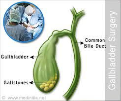 We did not find results for: Gallbladder Surgery Complications Side Effects Faq