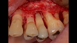 Treat Periodontal Gum Disease Before Placing Dental Implant Youtube