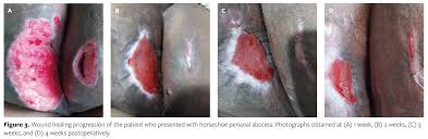 Image result for Perirectal Abscess